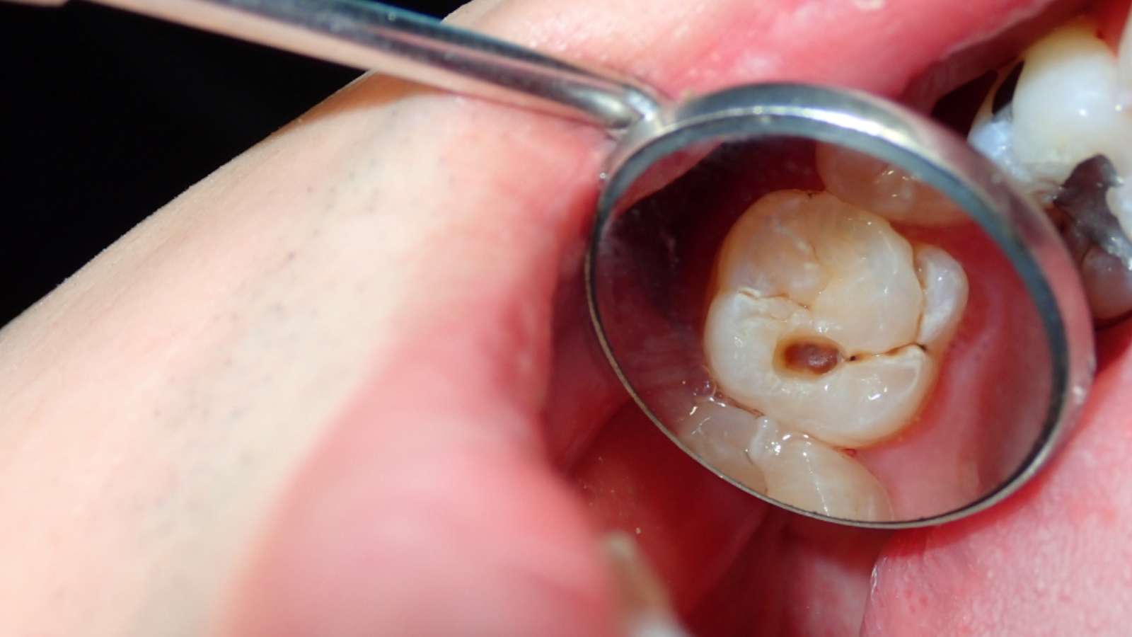 types of cavities - class 1 cavity