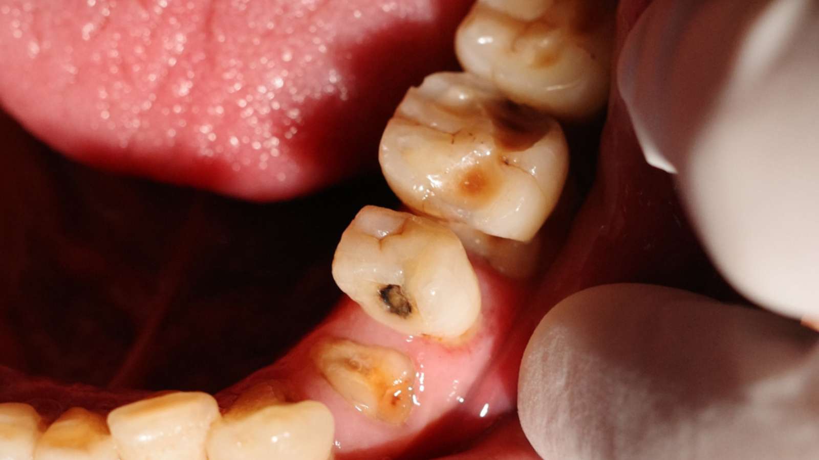 types of cavities - class 2 cavity