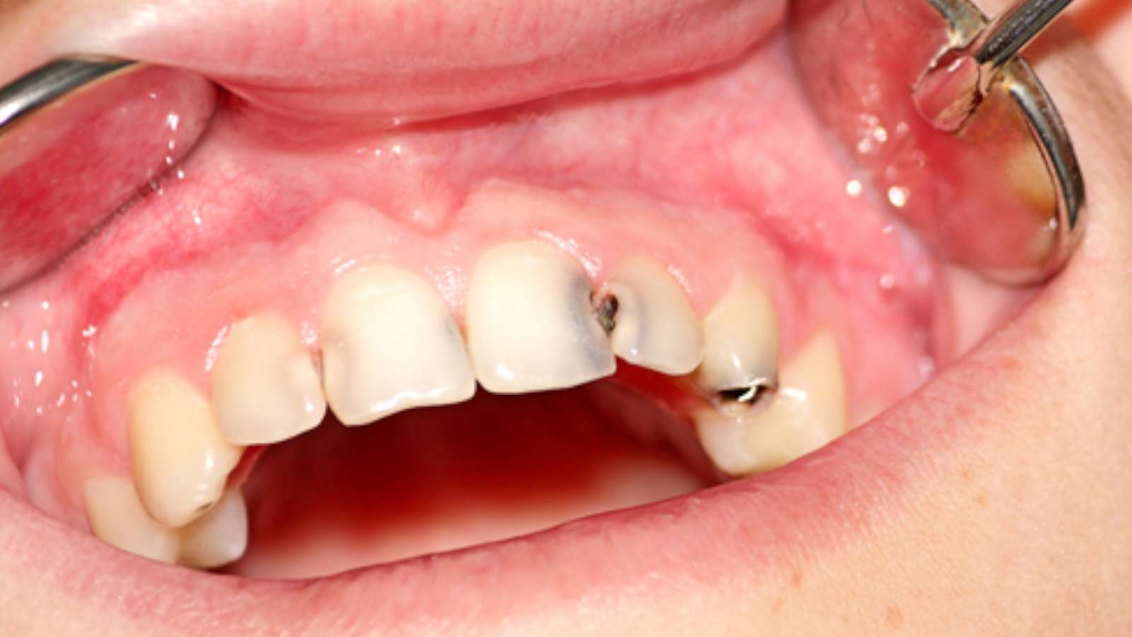 types of cavities - class 3 cavity