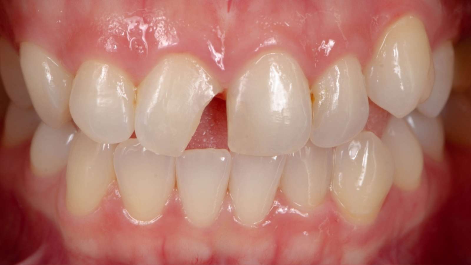 types of cavities - class 4 cavity