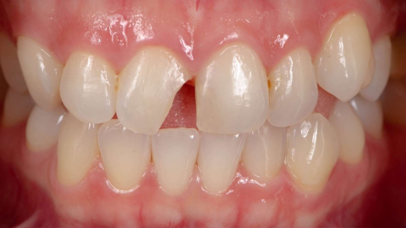 types of cavities - class 4 cavity