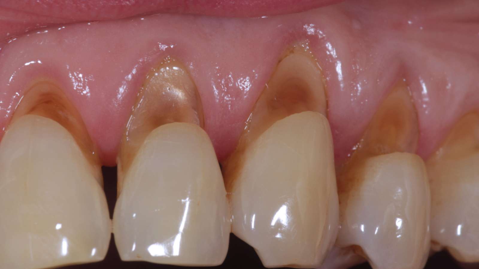 types of cavities - class 5 cavity