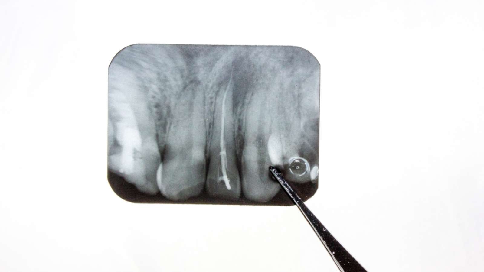 Complications From Dental Cavities - Image of a dental x-ray undergoing rct therapy
