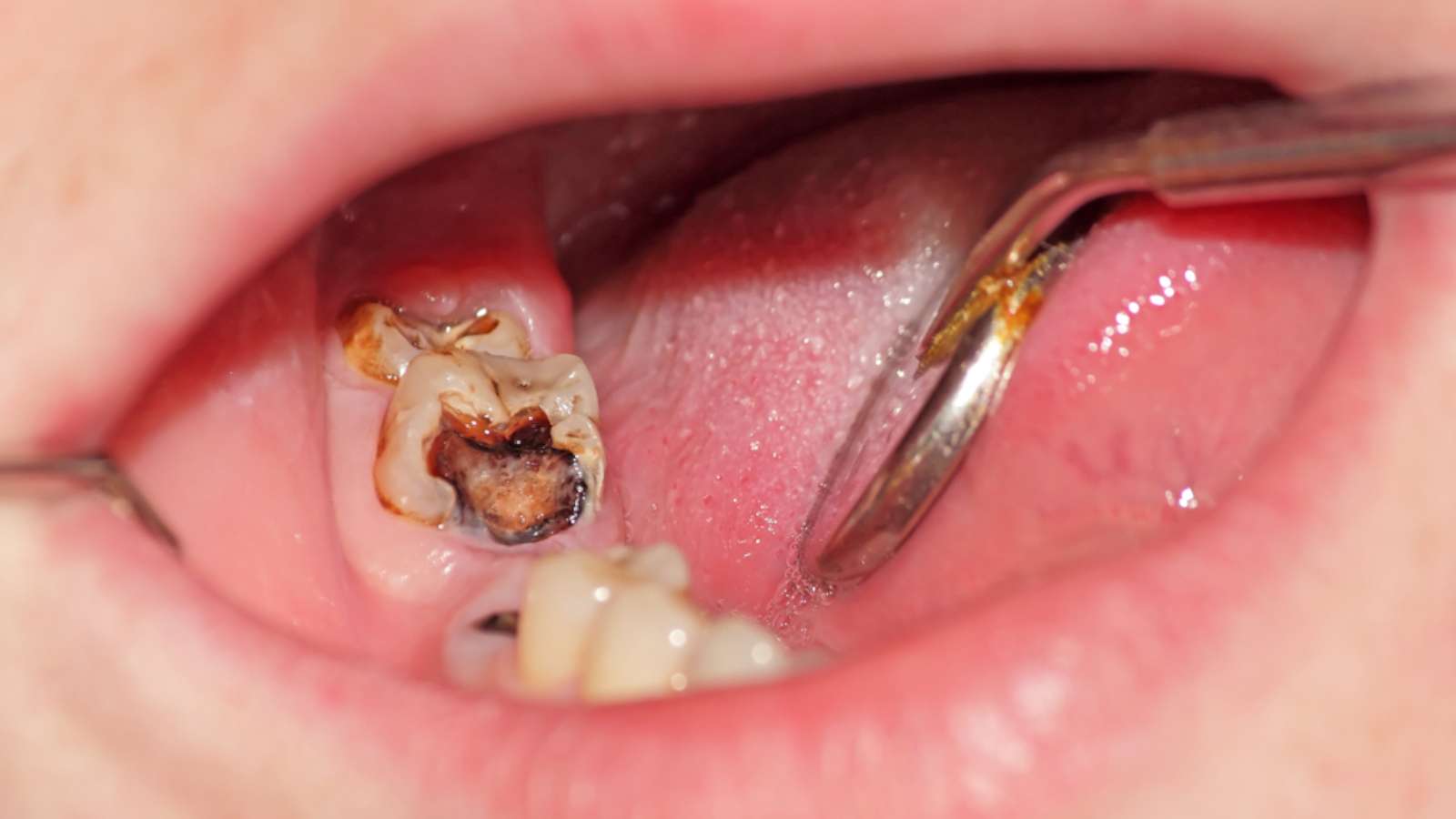 Complications From Dental Cavities - Image of a tooth with extensive destruction
