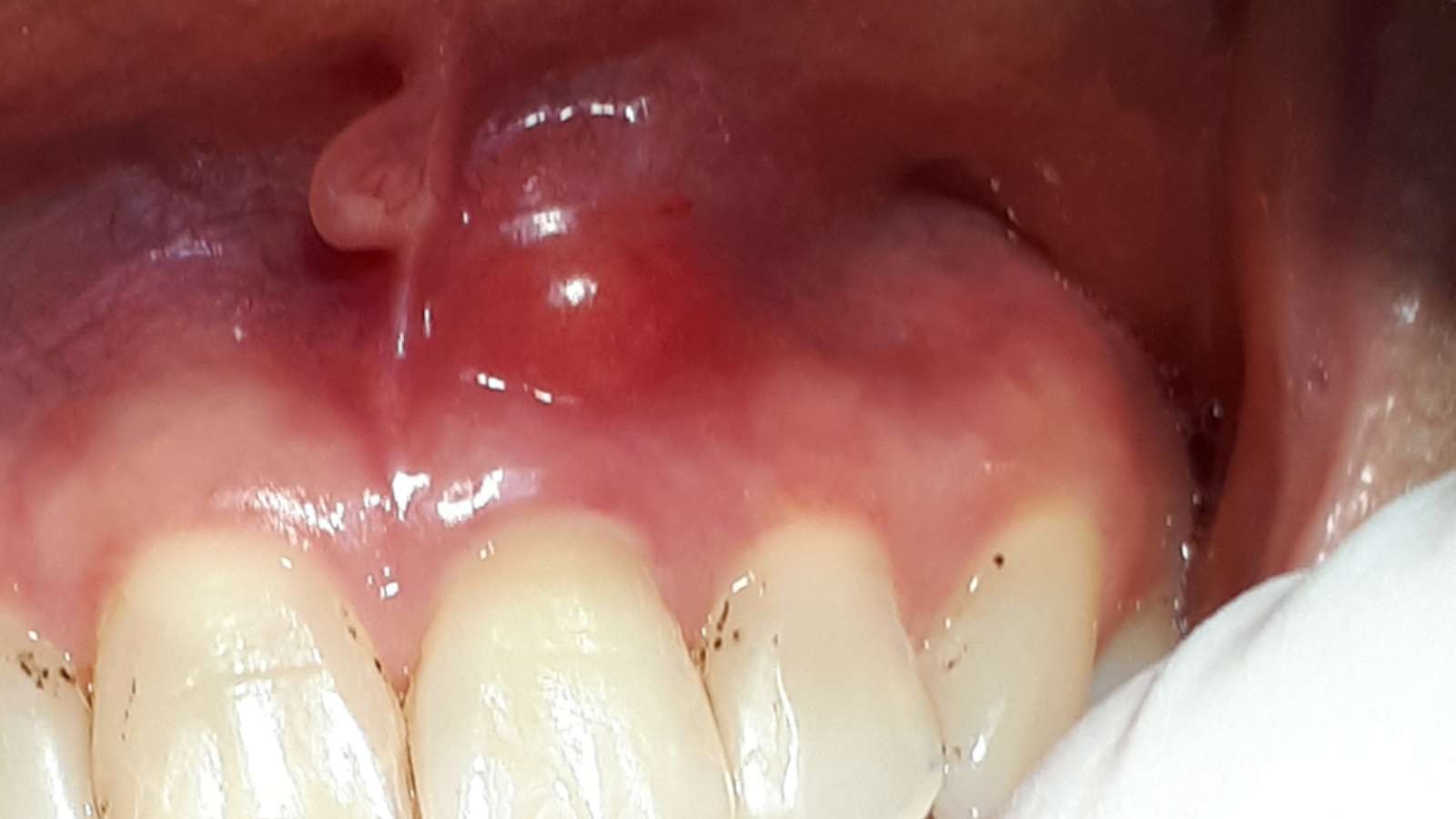 Complications From Dental Cavities - Image of a tooth with a gum swelling