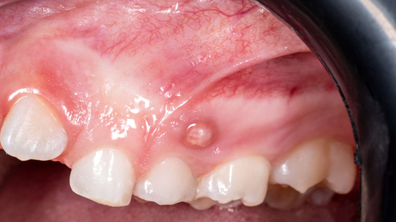 Complications From Dental Cavities - Image of a dental fistula