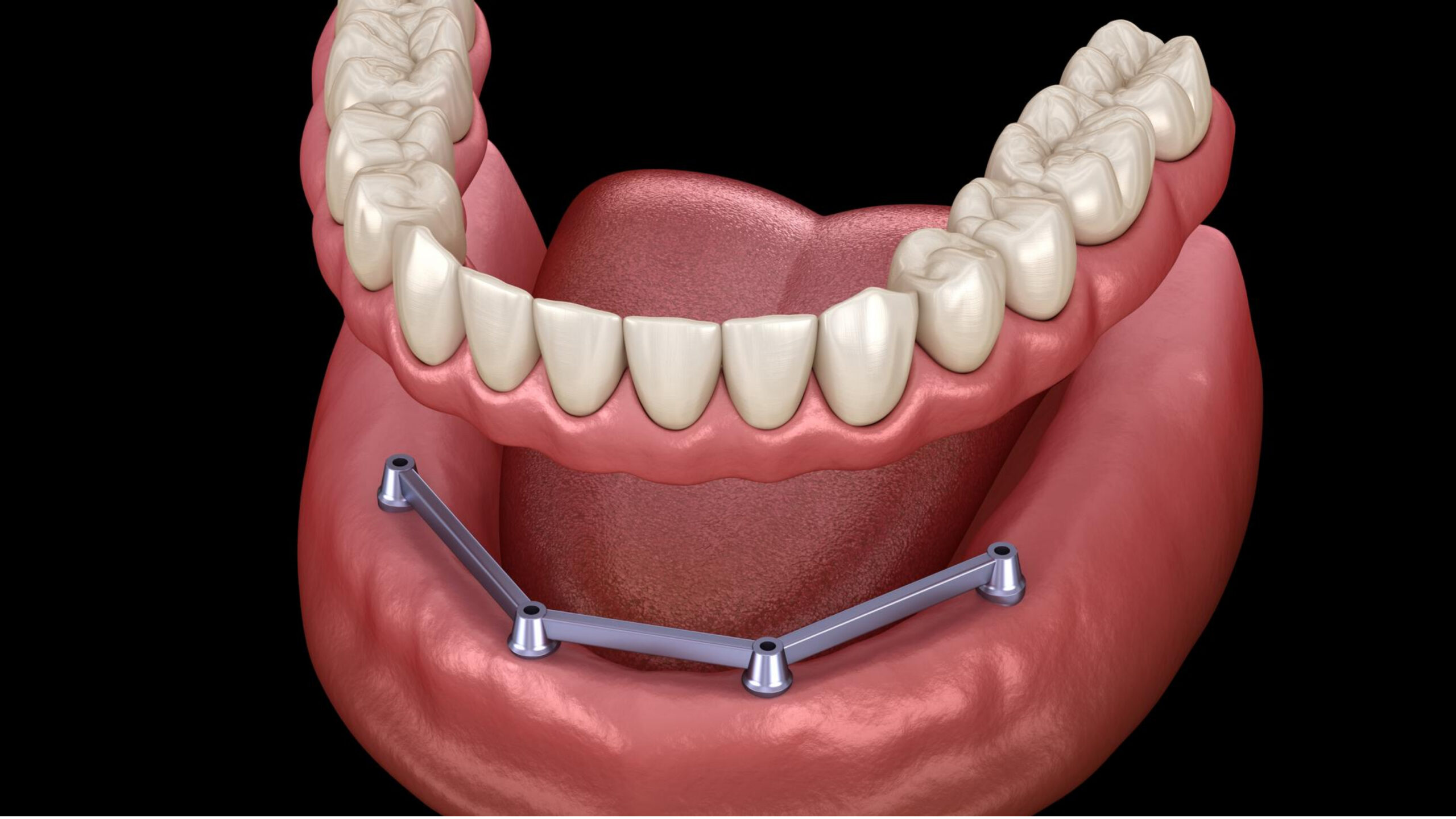 demonstration of all on 4 dental implants in a 3d model