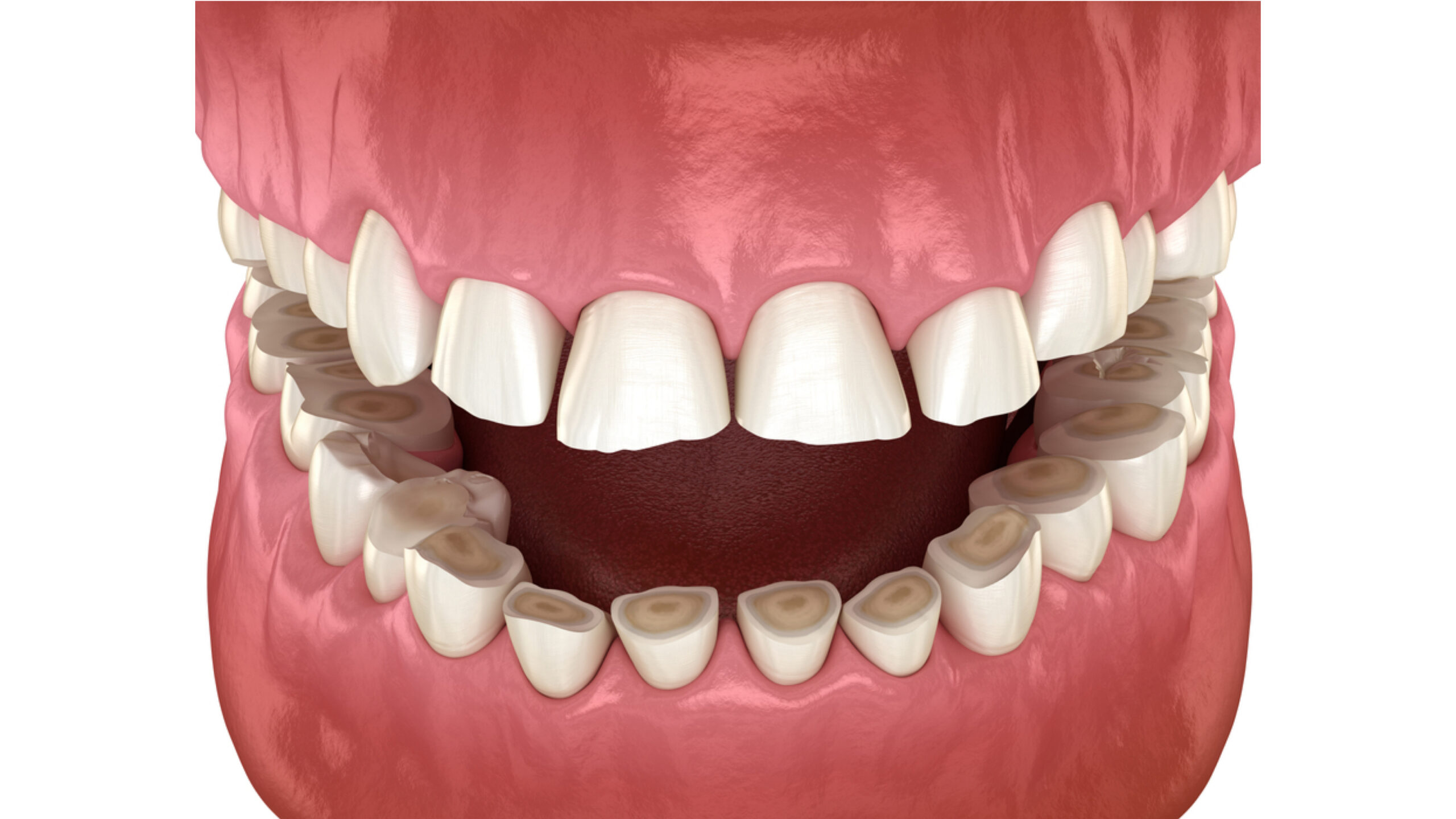 dental attrition and the consequent loss of tooth tissue, illustrated with a medically accurate 3D representation of a tooth