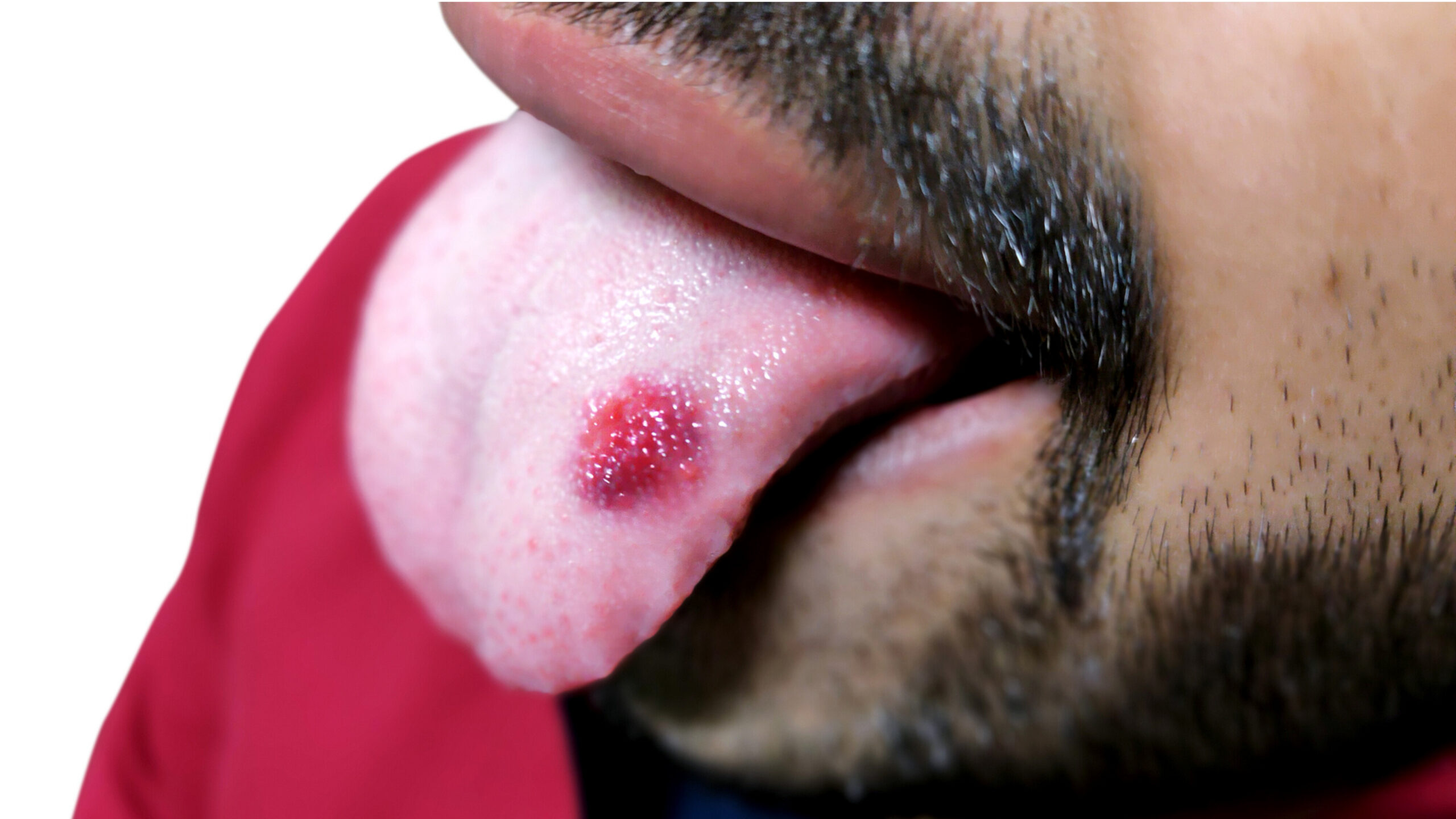 picture of oral lichen planus on a male tongue